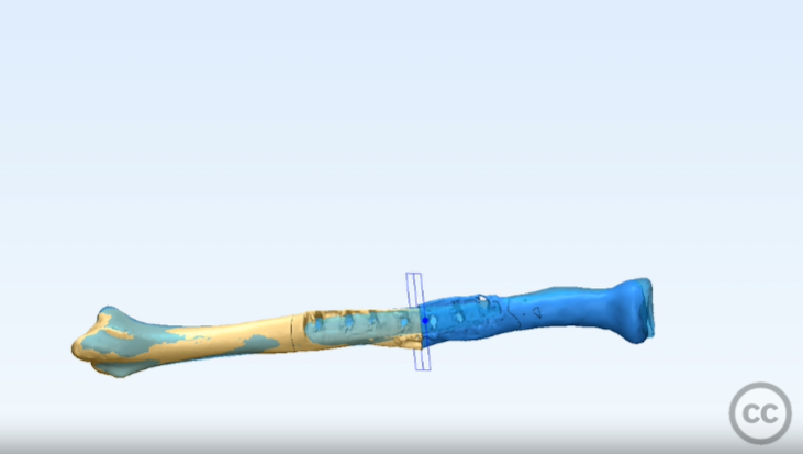 3d Printed Saw Guides And Provisional Plate For Corrective Osteotomy Of